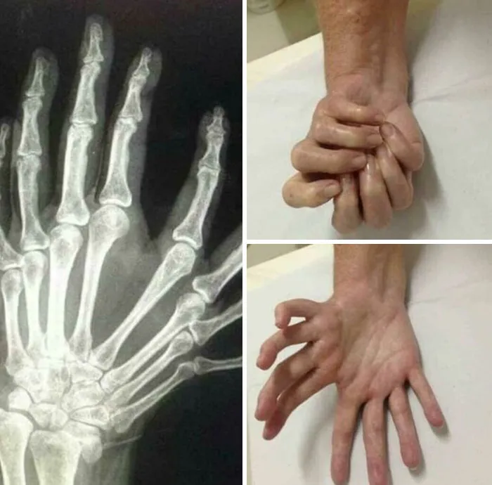 Radiografía y fotos médicas que muestran deformidades en las manos, evidenciando lo aterrador que puede ser el cuerpo humano.