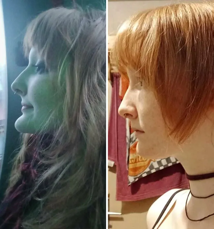 Chin Reduction Surgery Results