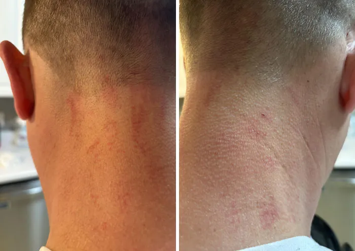 Close-up comparison of neck irritation and redness before and after a salon visit that led to a glow-up and breakdown experience.