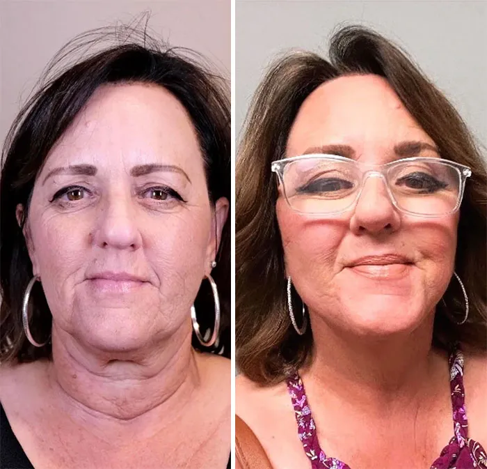 Face & Neck Lift