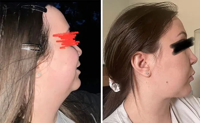 Todavía no puedo creer la transformación que me produjo el lifting de cuello