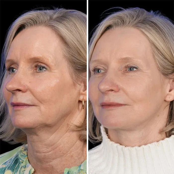 Lifting facial profundo con injerto de grasa: 6 meses después de la operación