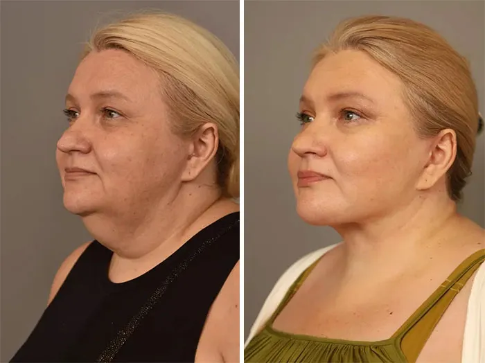 Lifting facial completo y liposucción de cuello: resultados antes y después