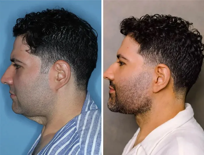 Lifting facial y de cuello tras una pérdida de 82 kg. Dos meses y medio después de la operación.