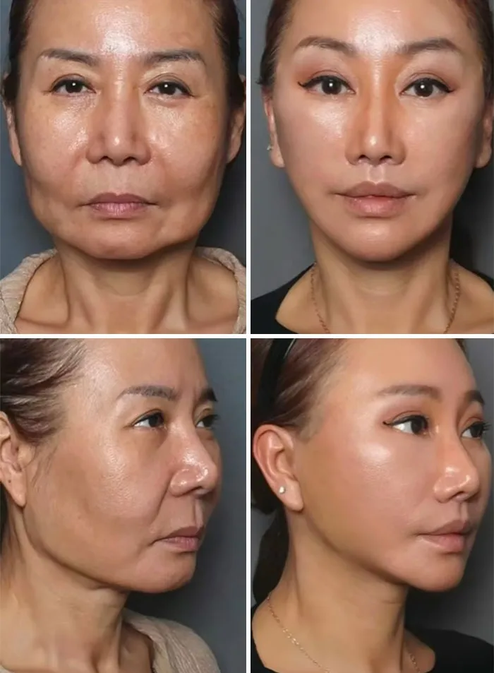58 Year Old 1 Month After Looks 20 Years Younger