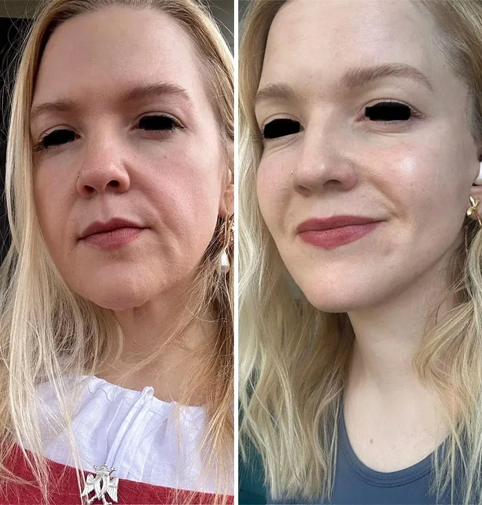 Lifting facial antes y después: 3 semanas después de la operación