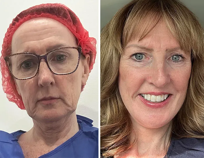 2 meses después de la operación de lifting facial y de cuello profundo más blefaroplastia superior