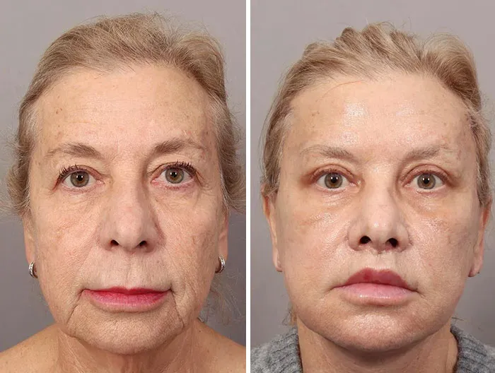 Mujer mayor antes y después de cirugía plástica, mostrando resultados de rejuvenecimiento facial y mejoras estéticas.
