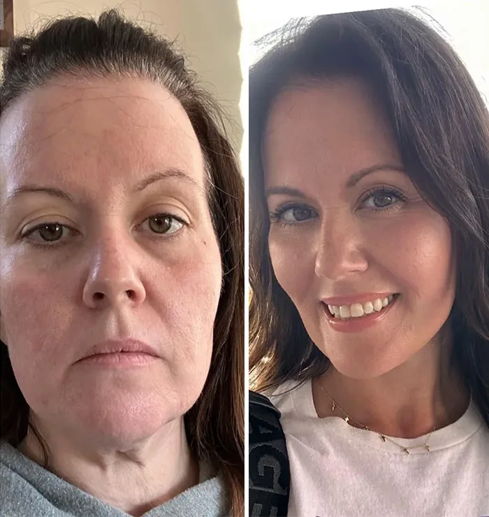 Lifting facial y de cuello profundo tras una pérdida de peso importante