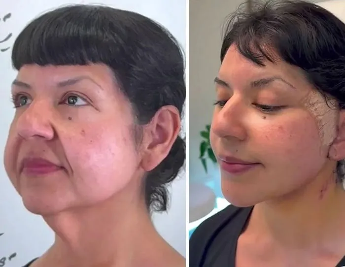 Lifting facial y de cuello en Guadalajara
