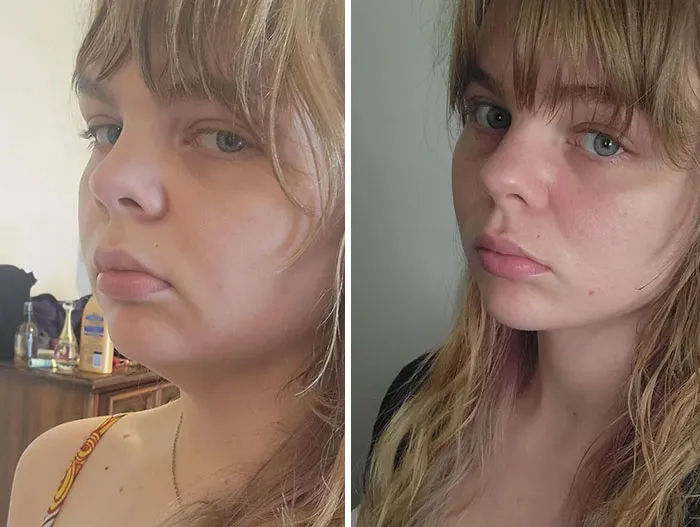 Results From My Facelift And Neck Lift At 30 Years Old