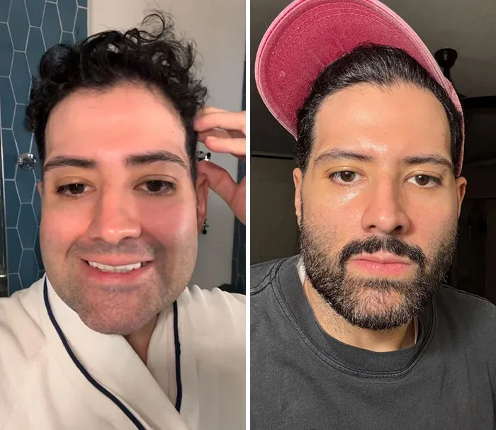 40 años, 8 meses después de una cirugía de lifting facial, tras perder 82 kilos.