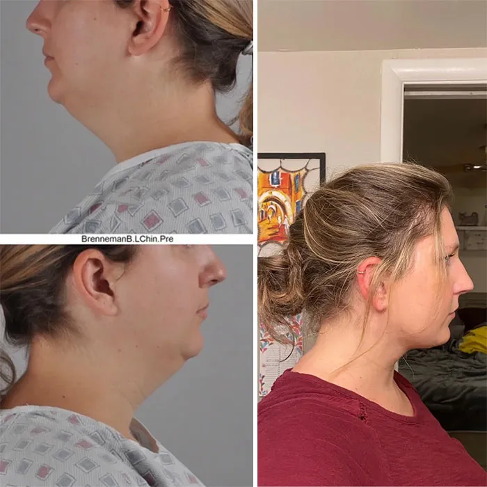 3 meses tras el lifting de cuello