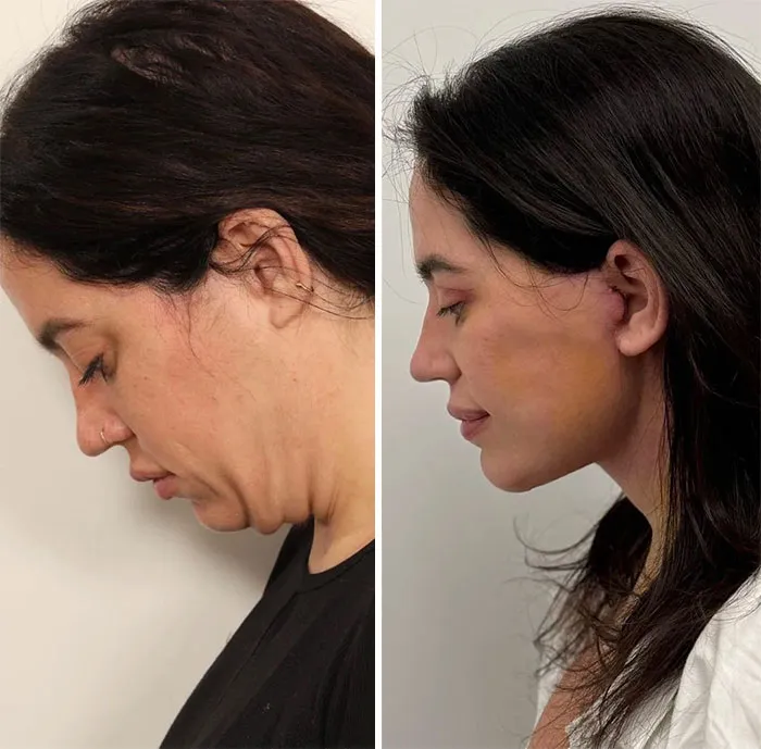 1 semana después de un lifting facial y de cuello profundo y de blefaroplastia superior