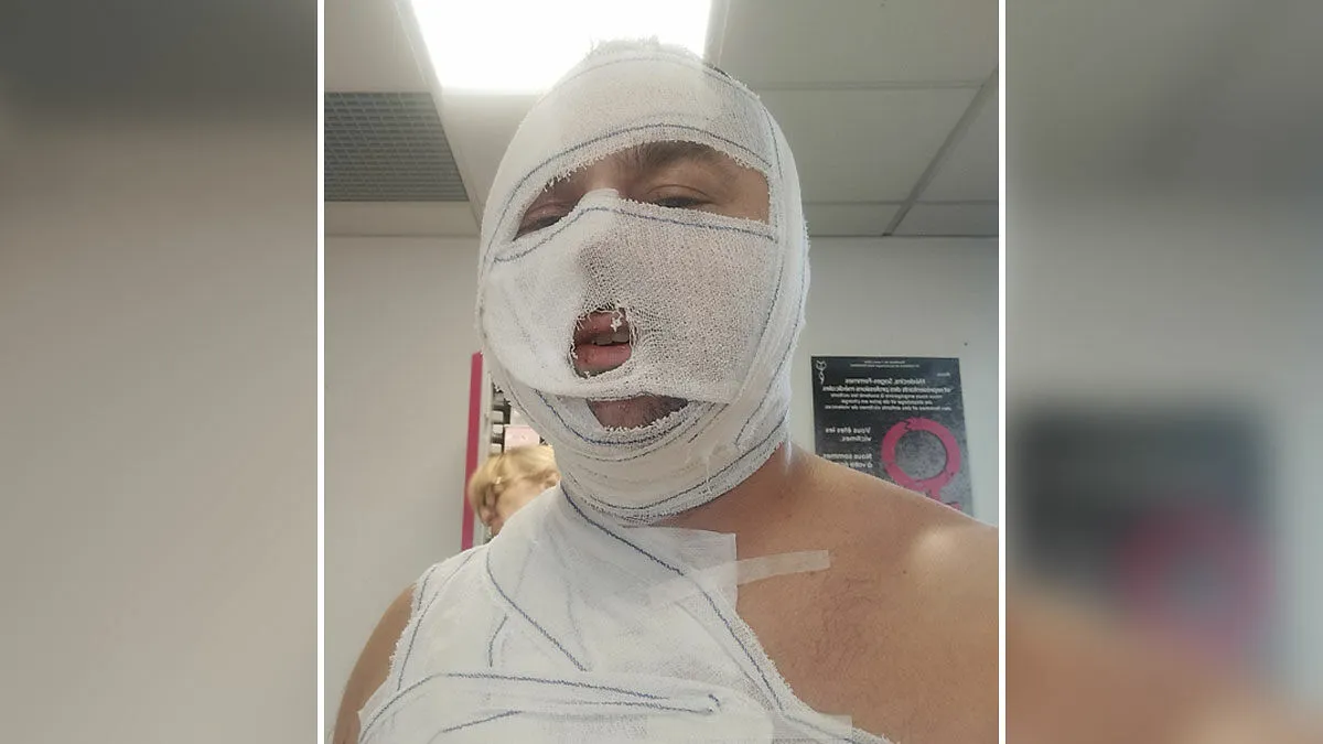 Man Wins Landmark Domestic Violence Case Against Ex-Girlfriend Who Scalded And Hospitalized Him
