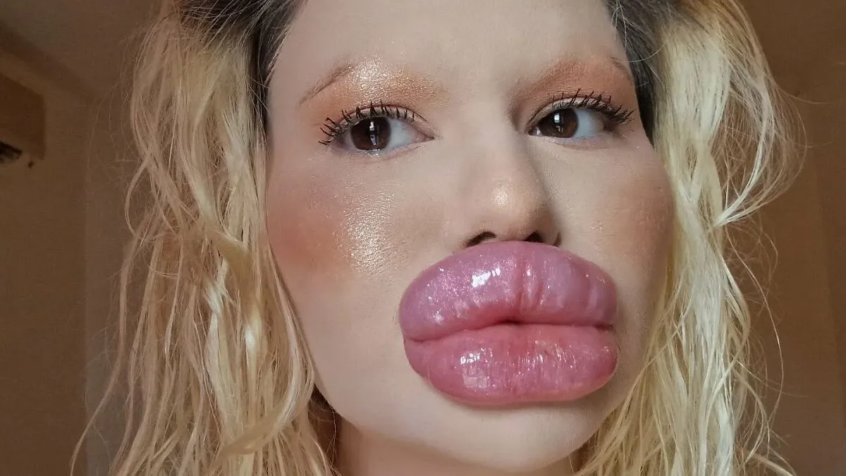 Woman With 'World’s Biggest Lips' Shares What She Looked Like Before $26K Extreme Surgeries