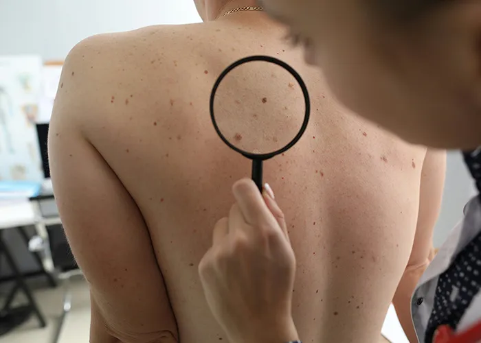 Doctor examining skin moles with magnifying glass, highlighting concerns related to death machines in medical context.
