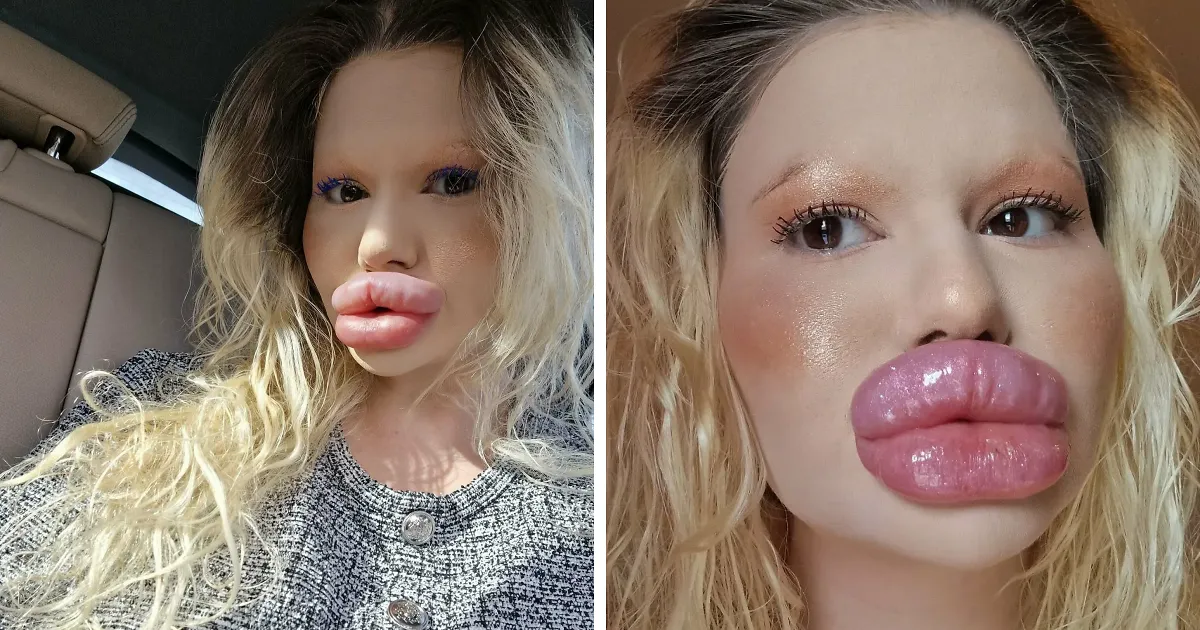 La mujer con los "labios más grandes del mundo" comparte cómo se veía antes de gastarse $26000 en cirugías extremas