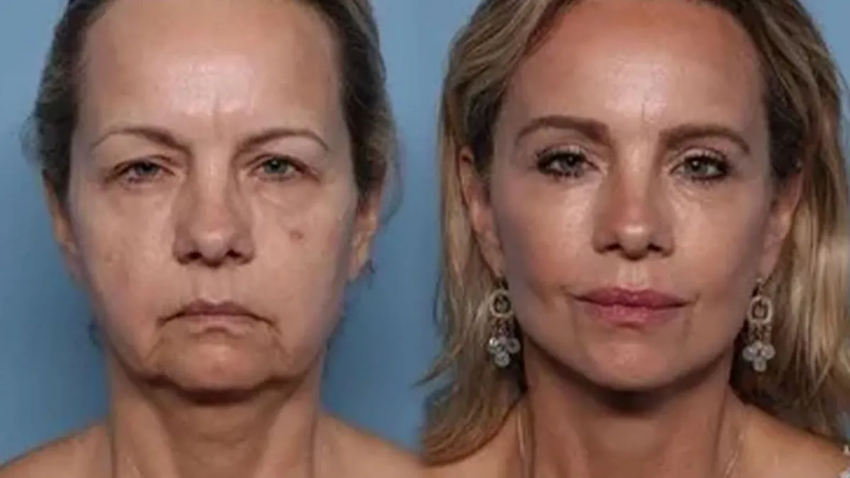 50 People Who Look Unrecognizable After Plastic Surgery