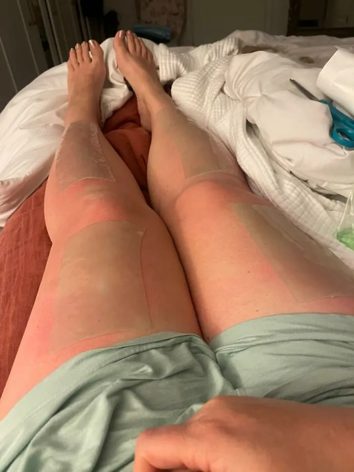 Your Angry, Lobster-Red Skin Can Get Some Sweet, Soothing Relief After A Little Too Much Sun With An <a Style="Display:inline;" Href="Https://Www.amazon.com/Organic-Aloe-Sunburn-Relief-Termaburn/Dp/B0bvdcnznr?ie=utf8&linkcode=ll1&tag=bpsquid-20&linkid=5e0367524024759ca689f28ba5e8afaa&language=en_us&ref_=as_li_ss_tl" Target="_blank">  <span Style="Font: Inherit; Color: #d74b1f;"> Aloe Wrap For Sunburn Relief</Span>