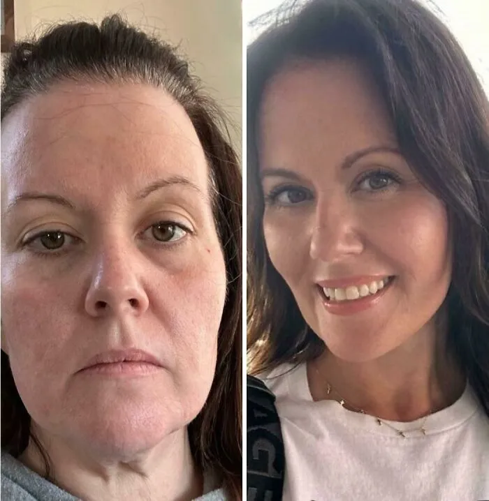 Deep Plane Face And Neck Lift After Major Weight Loss