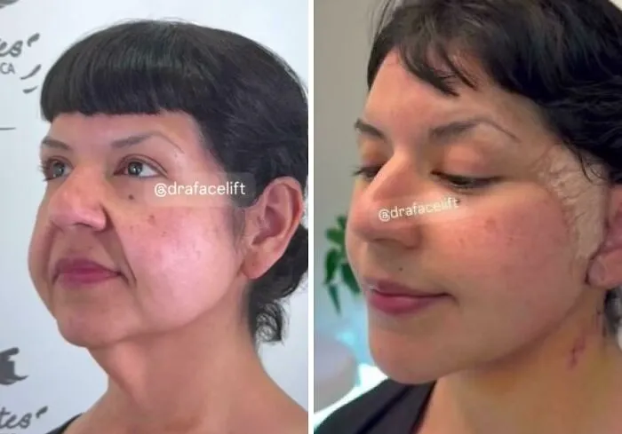 My Neck And Face Lift In Guadalajara