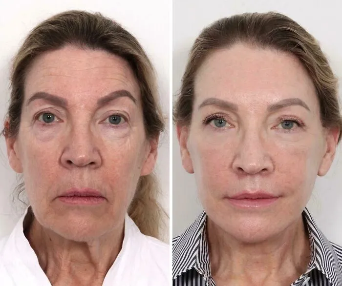 7 Weeks Post Facelift…