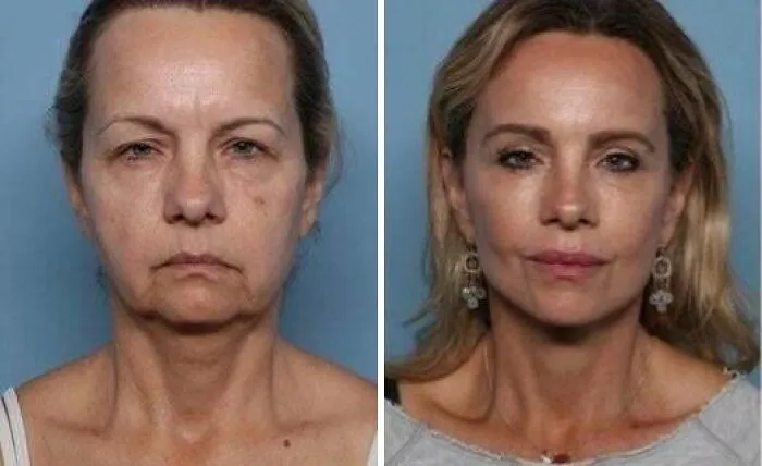 6 Month Post-Op @ 54 Years Old