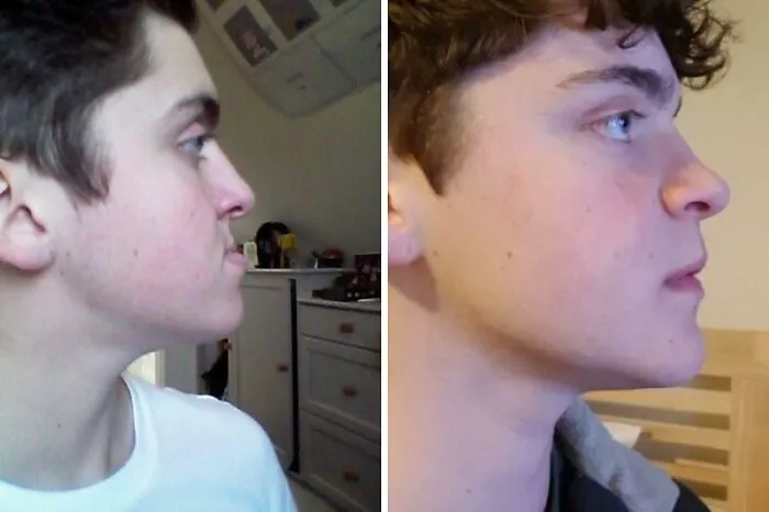 Before And After - Maxillofacial Surgery And Mentoplasty, One Year Apart