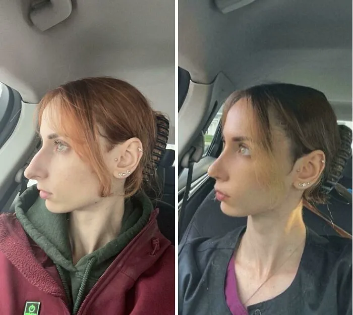 One Month Ago Today I Got My Nose Done And Could Not Be Happier With The Results!!✨