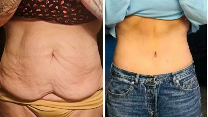 10 Months Post-Tummy Tuck