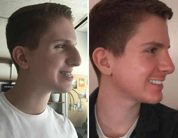 Before & After: Double-Jaw Surgery & Rhinoplasty