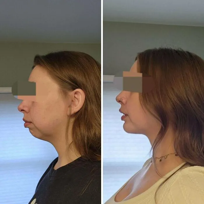 10mm Sliding Genioplasty 3 Month Update