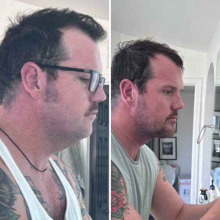 Platismaplastia + Sub Lipo + Implante de Mentón tras 1 semana