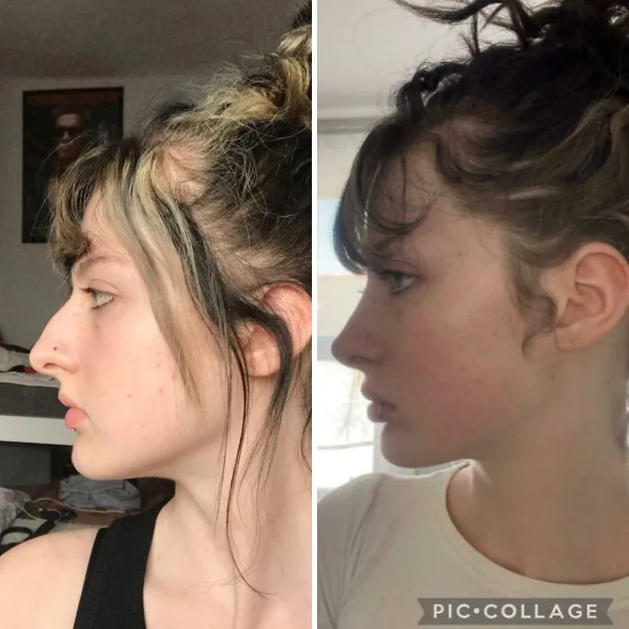1 Year Post Rhinoplasty