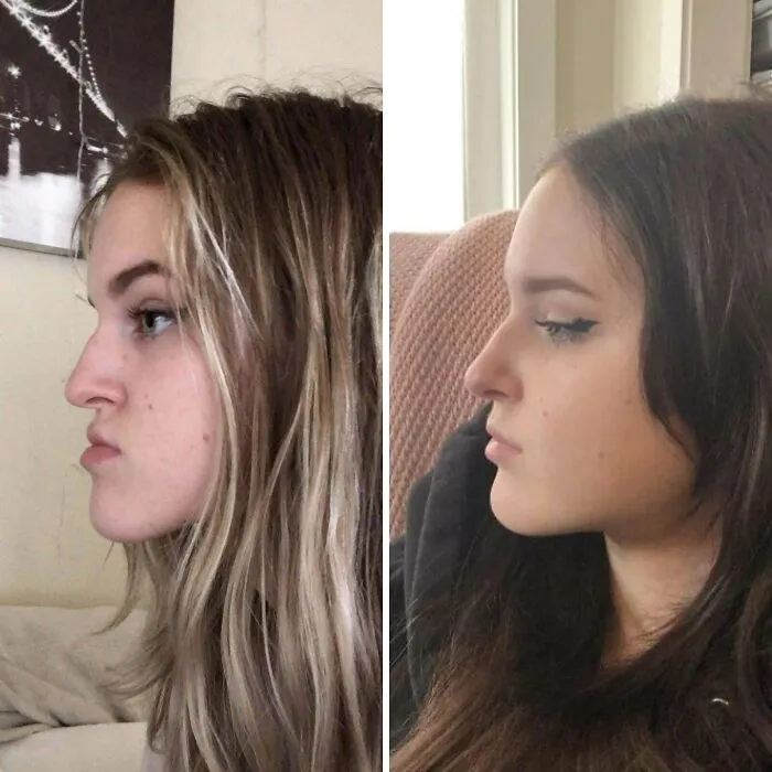 6 Months Post Double Jaw Surgery ! :)