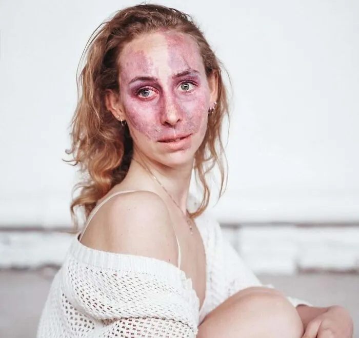 When People Ask Me What I Have On My Face, They Often Also Ask Me How I Deal With It