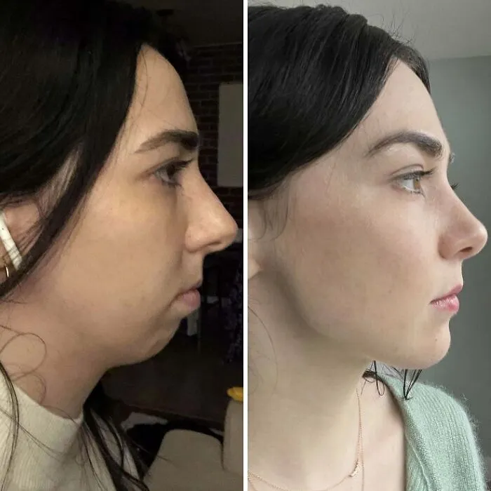 9.5 Months Post-Op From Jaw Surgery!