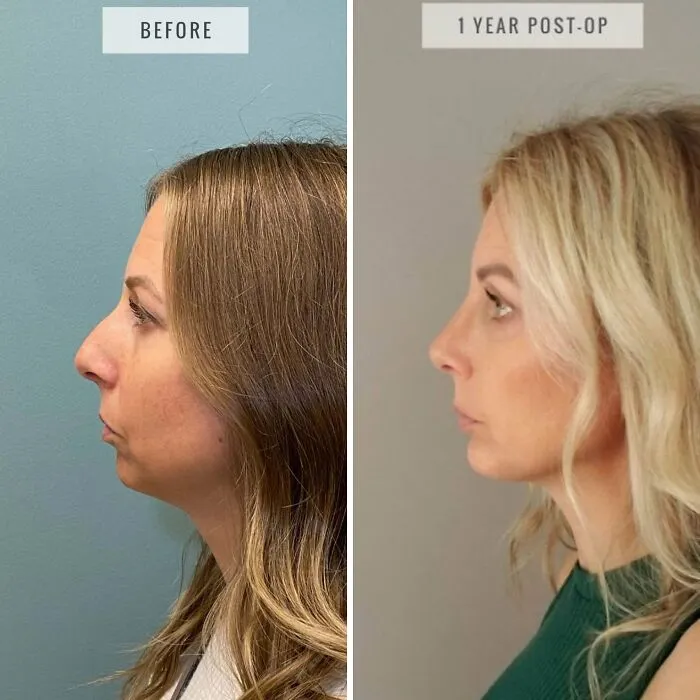 1 año después de la rinoplastia + implante de mentón