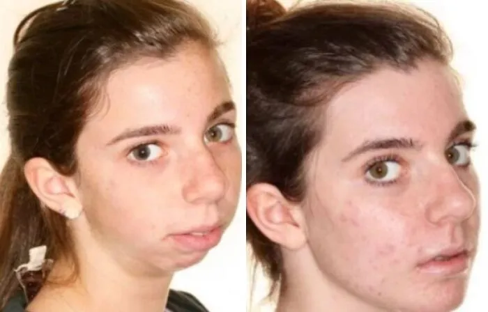 The Impact Orthognatic Surgery Can Have On Ones Appearance