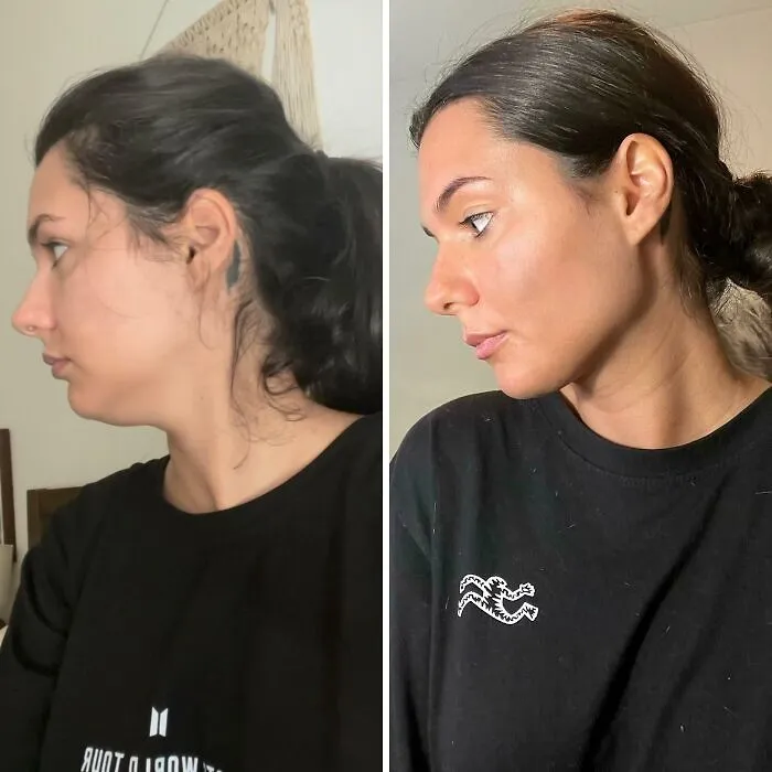 Mujer con cambio facial notable en comparación de antes y después tras cirugía plástica que la hace irreconocible.