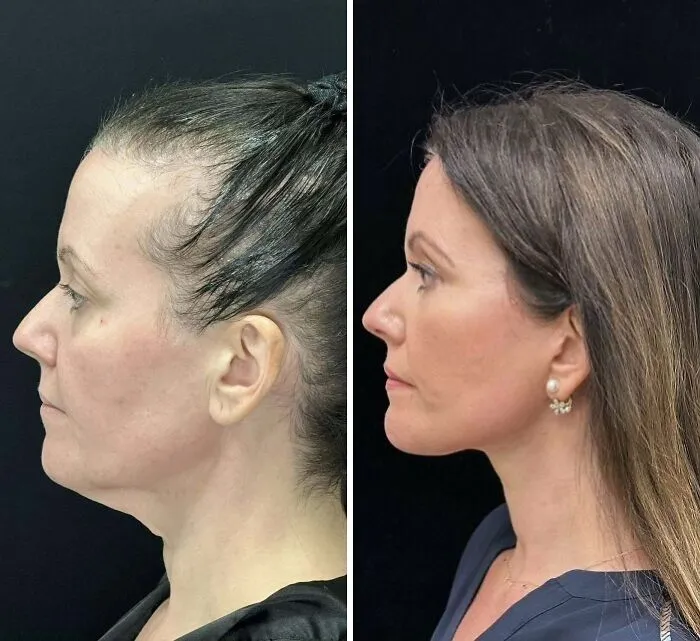 Antes y después de cirugía plástica mostrando cambio notable en el perfil facial en personas que se ven irreconocibles.
