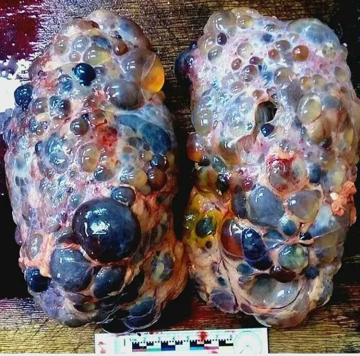 Polycystic Kidney Disease (Pkd)