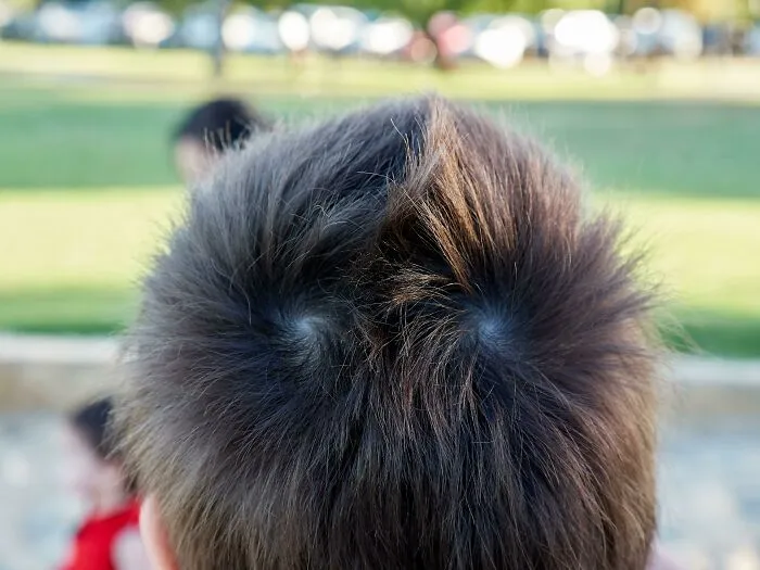 Mi hijo tiene 2 remolinos simétricos en el pelo que van en direcciónes opuestas. Así tiene una cresta de pelo natural