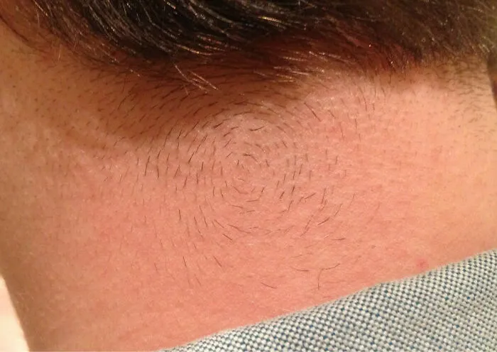 El pelo de mi cuello crece en círculo