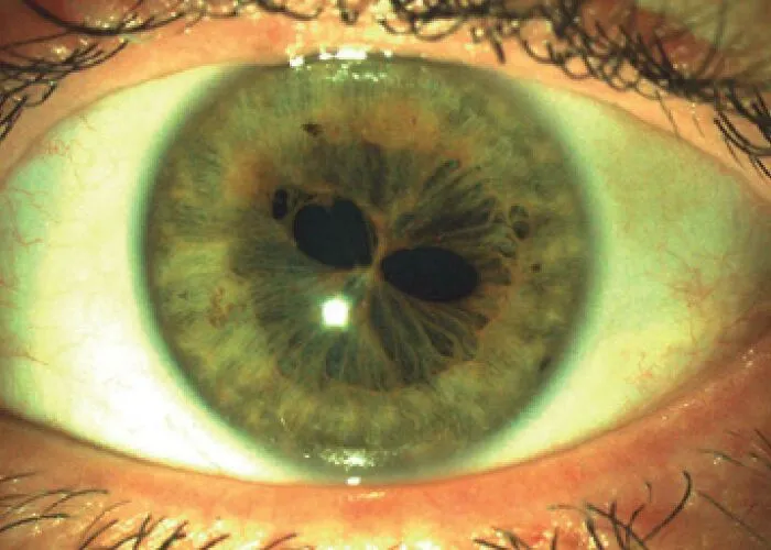 Ojo humano con policoria verdadera (pupilas múltiples)