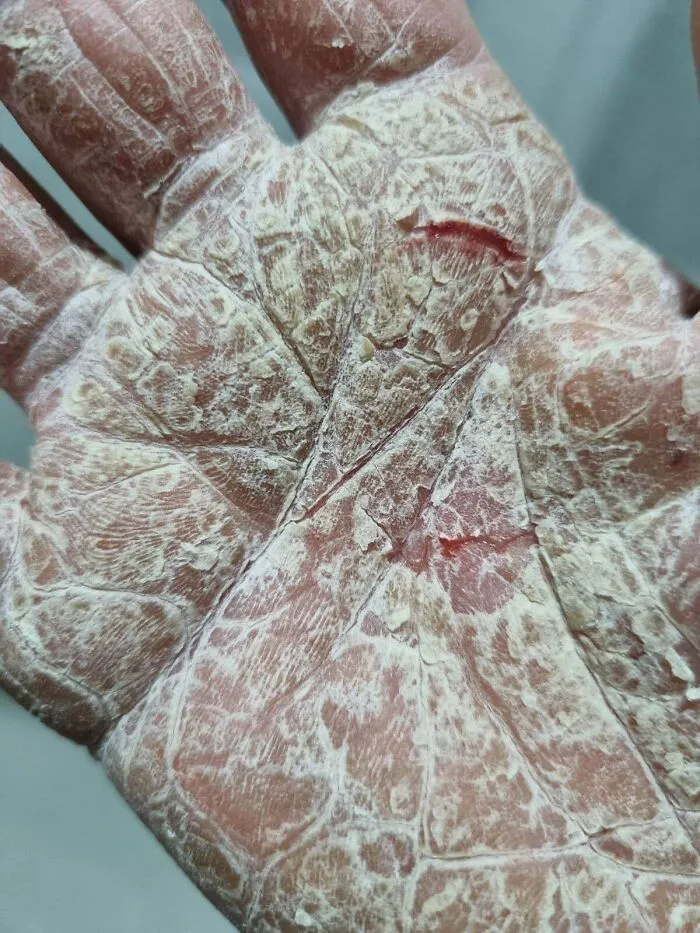 Mano con piel extremadamente seca y agrietada mostrando rasgos distintivos del cuerpo humano.