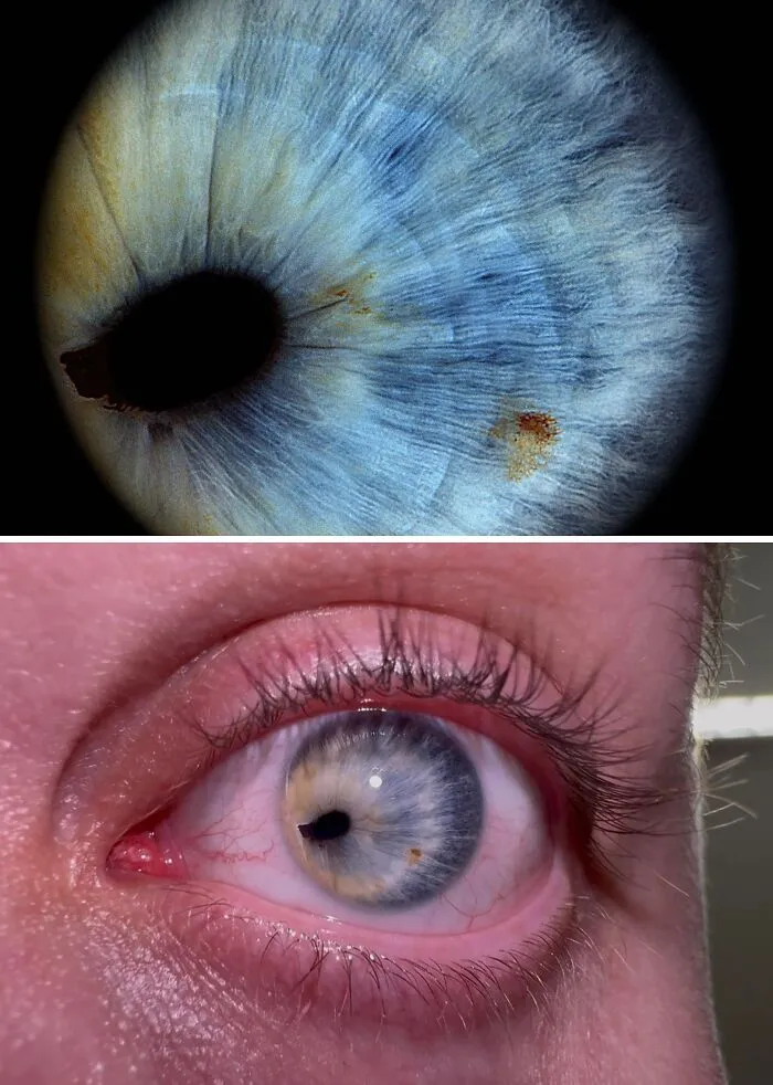 Corectopia: cuando la pupila no está en el centro del ojo. Veo igual de bien con mi ojo normal. 