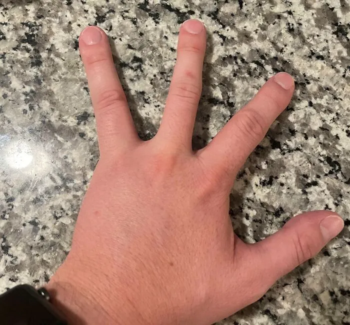 Nací con 4 dedos