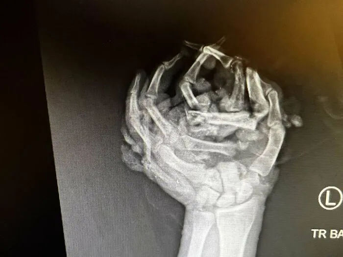 Mi mano izquierda se aplastó contra el techo de mi auto tras volcar. Radiografía de la noche del accidente.